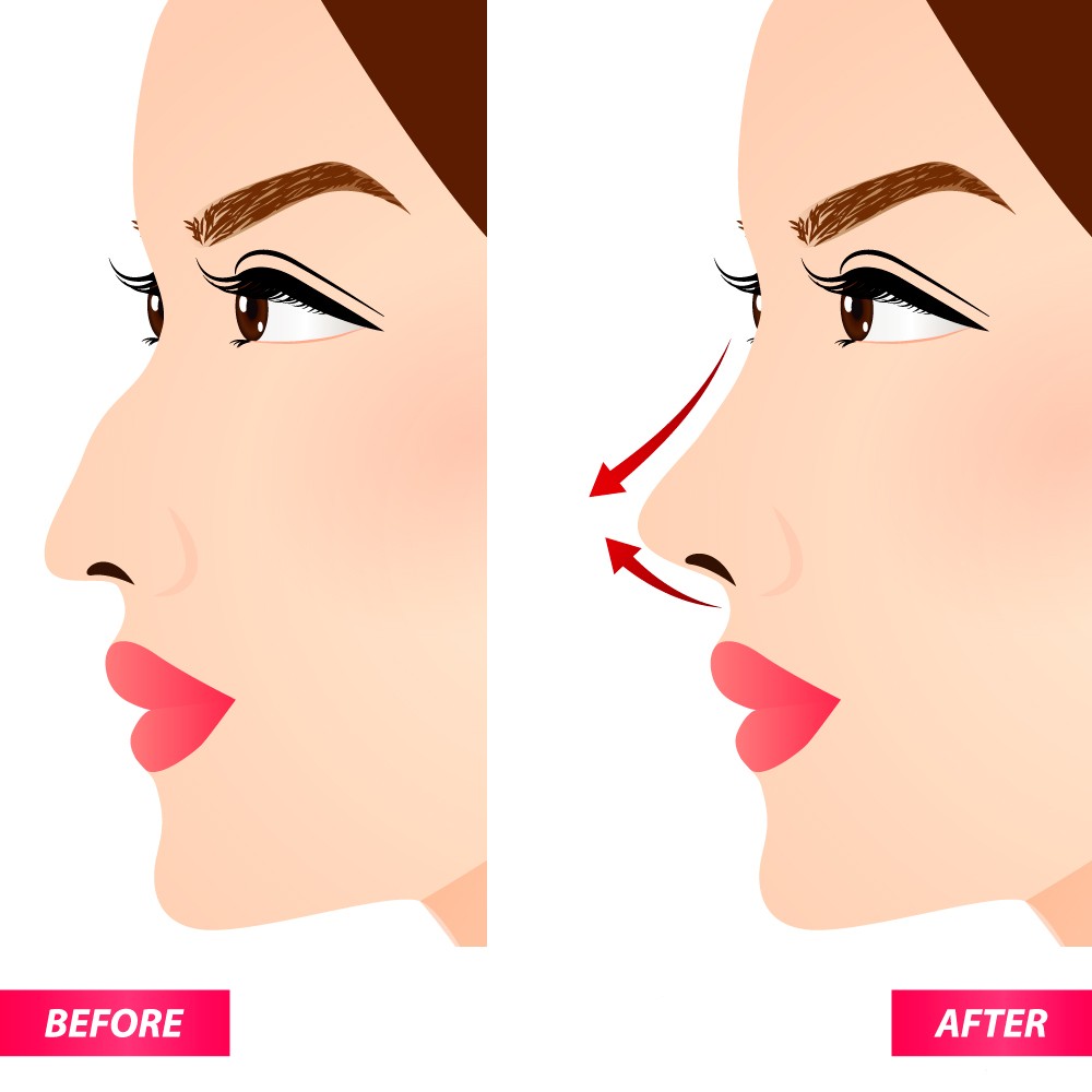 13 Tips to Speed Up Your Rhinoplasty Recovery Time