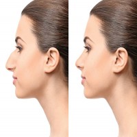 MY NOSE IS TOO BIG: WHAT ARE MY OPTIONS?