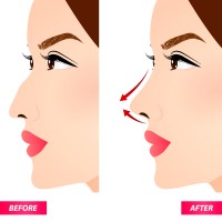 RHINOPLASTY AFFECTS