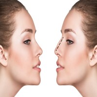 NOSE JOB: CHANGING THE SHAPE OF THE NOSTRIL